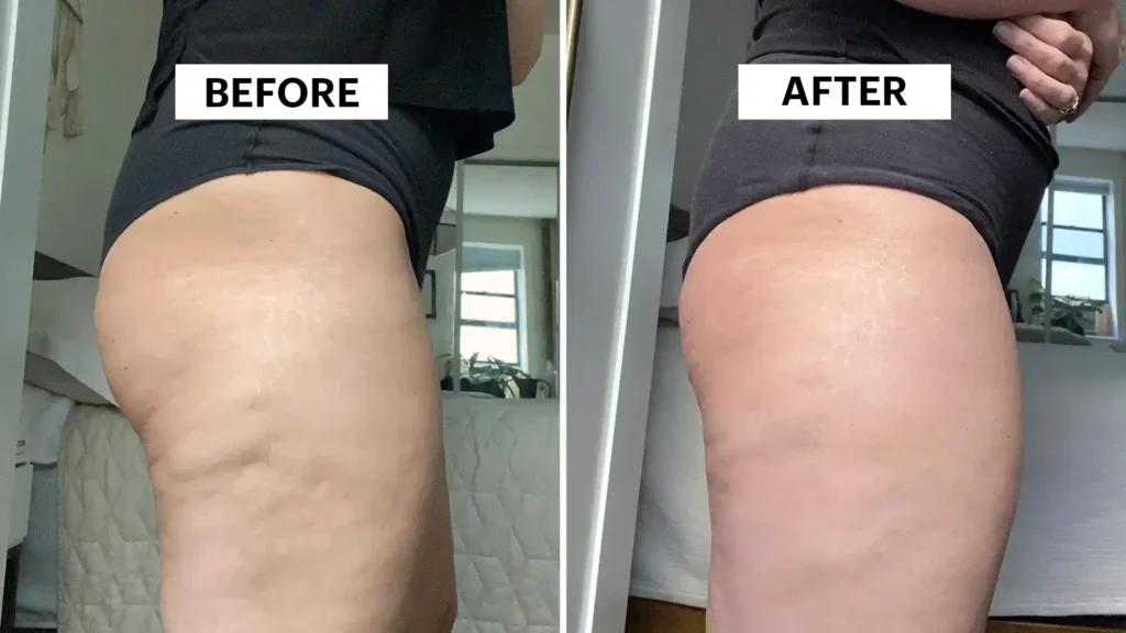 Sculpting Your Bum: Can Toning Exercises Really Reduce Cellulite? 1 Do Toning Exercise Rotherham Really Tackle Cellulite?