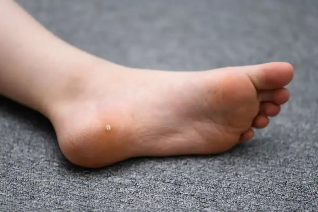 Cryotherapy For Warts And Also Verrucas 2 Image of verruca on the bottom of the foot that able to be treated with Cryotherapy Rotherham