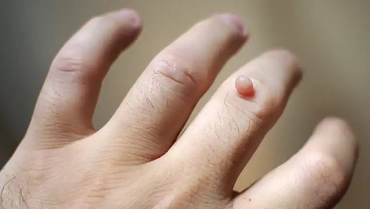 Cryotherapy For Warts And Also Verrucas 1 Image of blemish that Cryotherapy Rotherham can remove with Lipo 360.