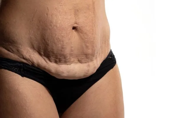 The Science of Skin Tightening 1 The science behind skin tightening Rotherham picture of a woman's sagging skin on the stomach